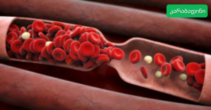 კარაბადინი (58)