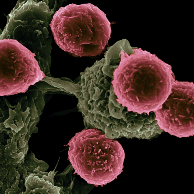 adenokarcinoma